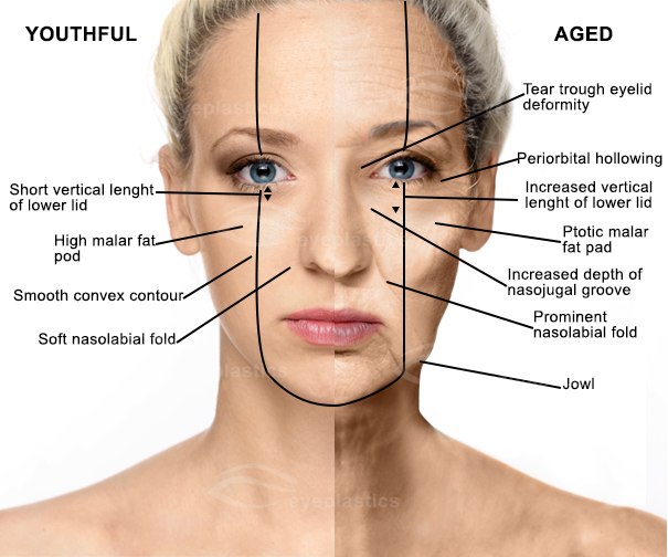 Face Lift Facelift Face Lift